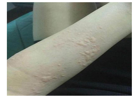 银屑病症状