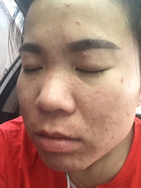 荨麻疹