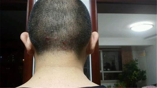 青春痘怎么治疗最好方法